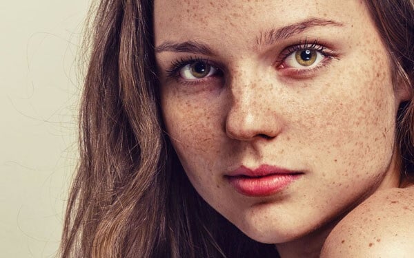 Microdermabrasion for pigmentation and blemishes
