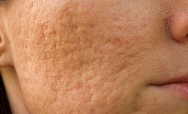 acne sufferers