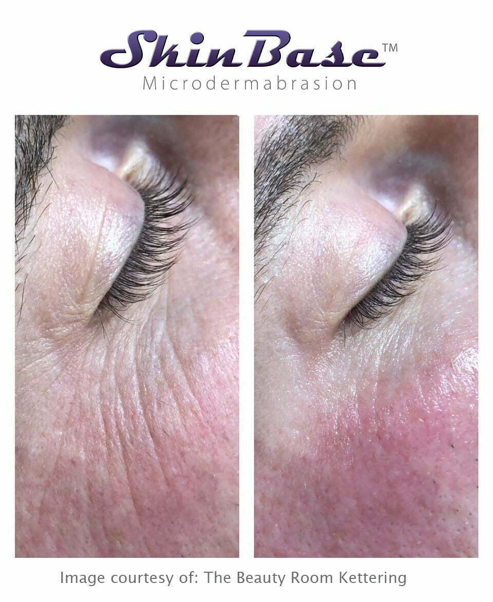 Microdermabrasion Results from face and body treatments