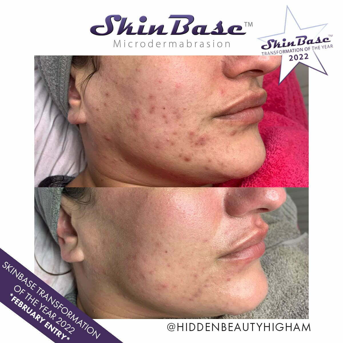 Before and after microdermabrasion