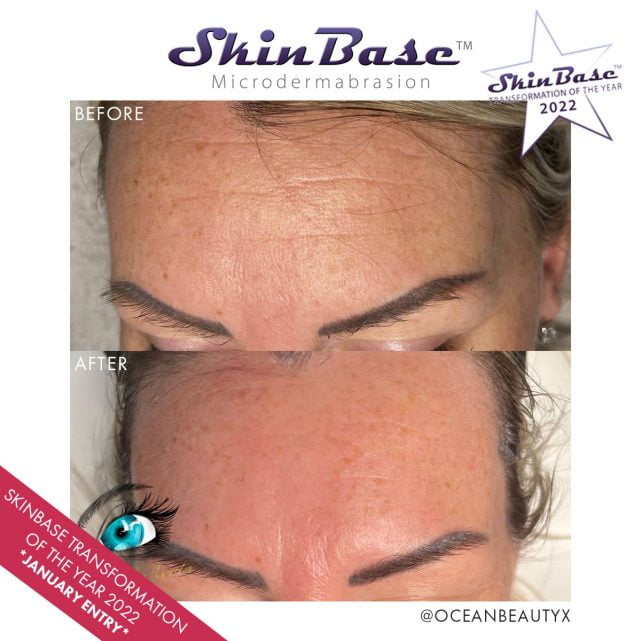 Microdermabrasion Before and After Images