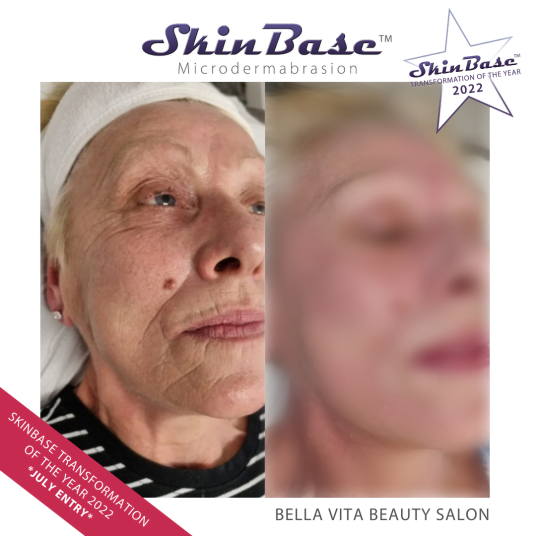 Microdermabrasion Transformations