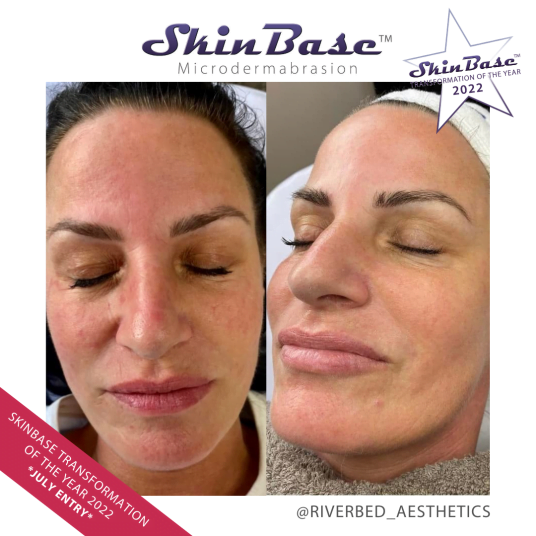 Microdermabrasion transformations riverbed aesthetics