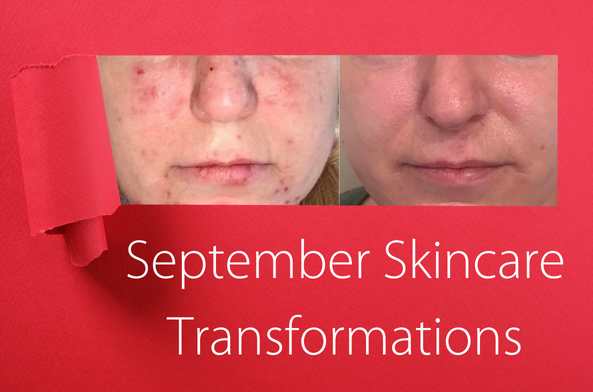 September skincare transformation