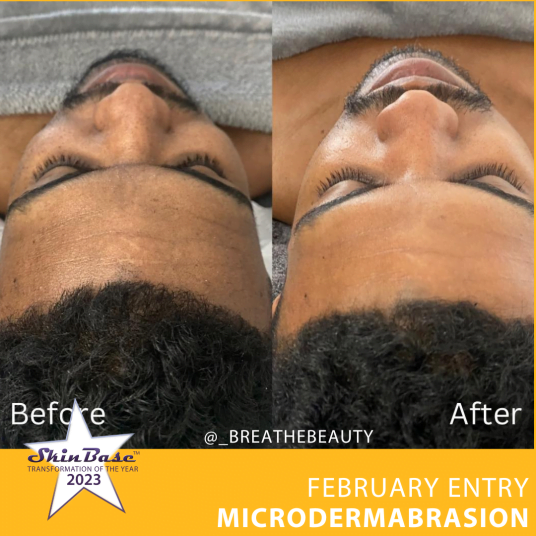 before and after microdermabrasion for uneven skin tone - February voting