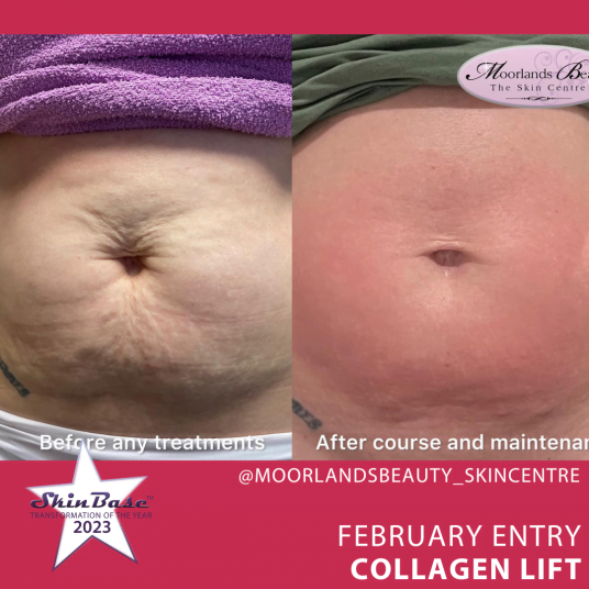 February voting - Before and After Collagen Lift for skin laxity and stretch marks